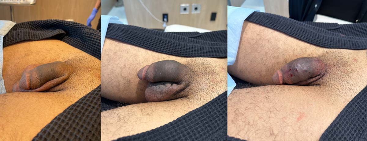 ONE PATIENT’S FILLER TREATMENT: View 2. Treatment photographs from EMER Male Clinic. The interval between these views is not available.
