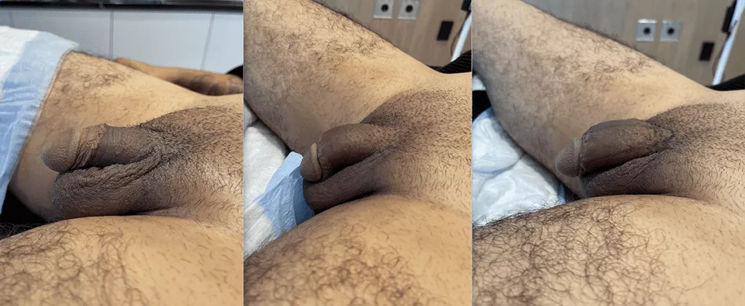 0623_Penis_Filler_Before_and_after_side_2-1080x444