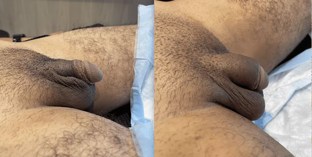 0623_Penis_Filler_Right_Side_Before__After-1080x545