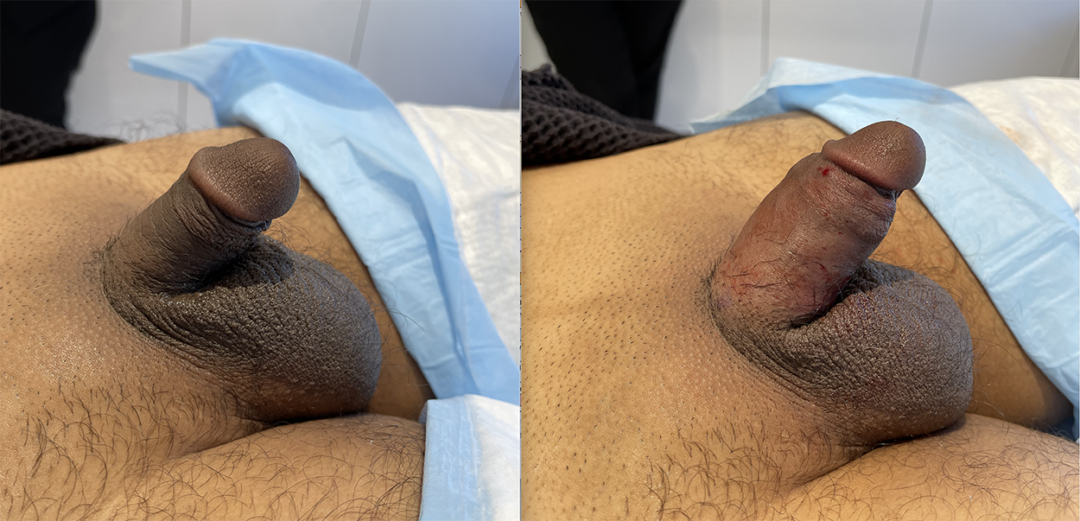 0624_Penile_Enhancement_right_side-1080x521