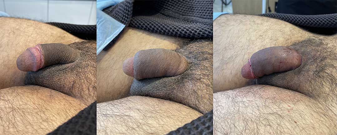 251321-4