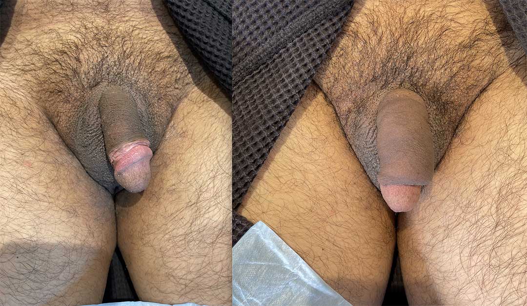 251321-5