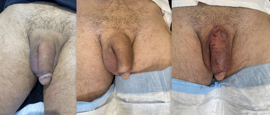 Before-and-After-Penis-Filler-3-1080x460