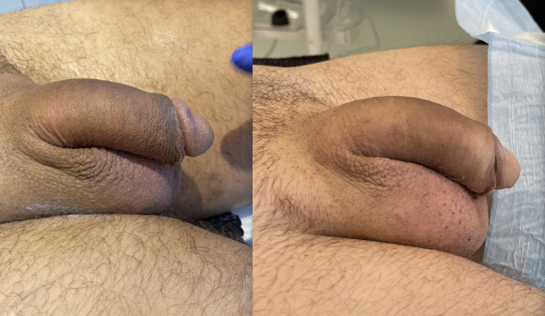 Before-and-After-Penis-Filler-4-1080x627