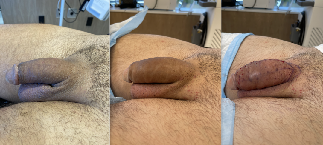Before-and-After-Penis-Filler-5-1080x486
