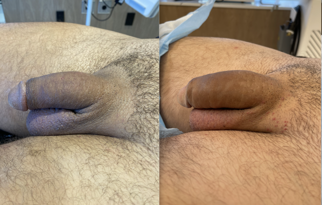 Before-and-After-Penis-Filler-6-1080x690