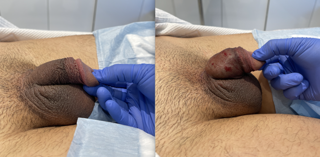 Penis-Filler-1-1-1080x530