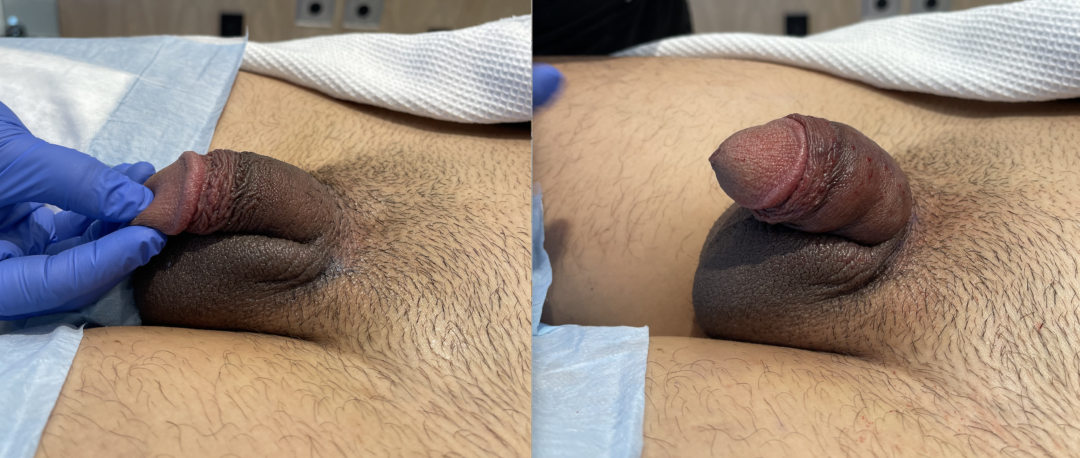 Penis-Filler-2-1-1080x458