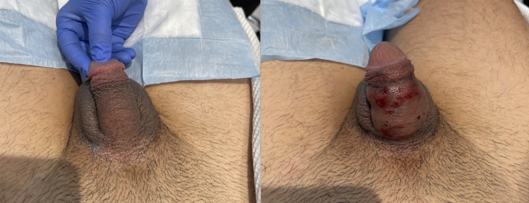 Penis-Filler-3-1-1080x414