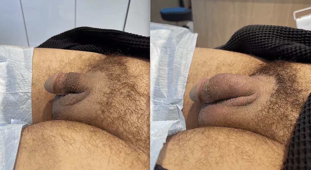 penile-filler-250277-bxa