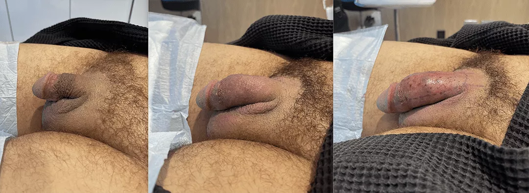 penile-filler-250277-bxa1