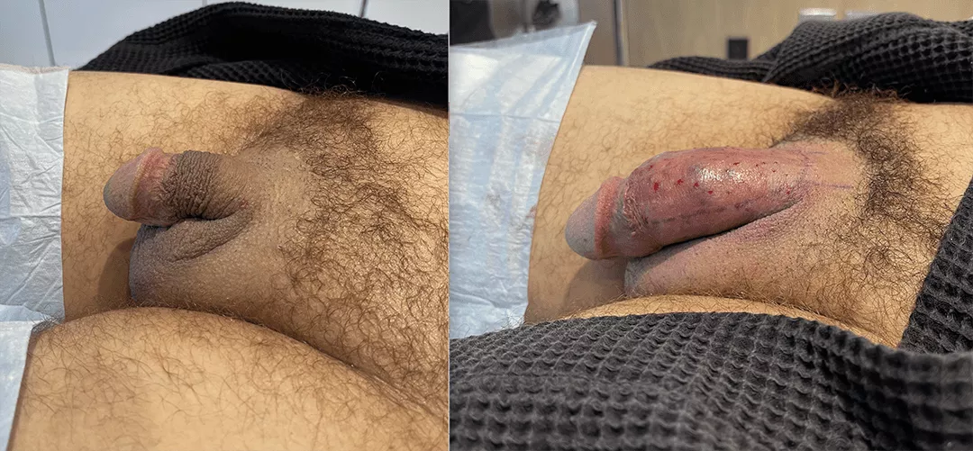 penile-filler-250277-bxa2