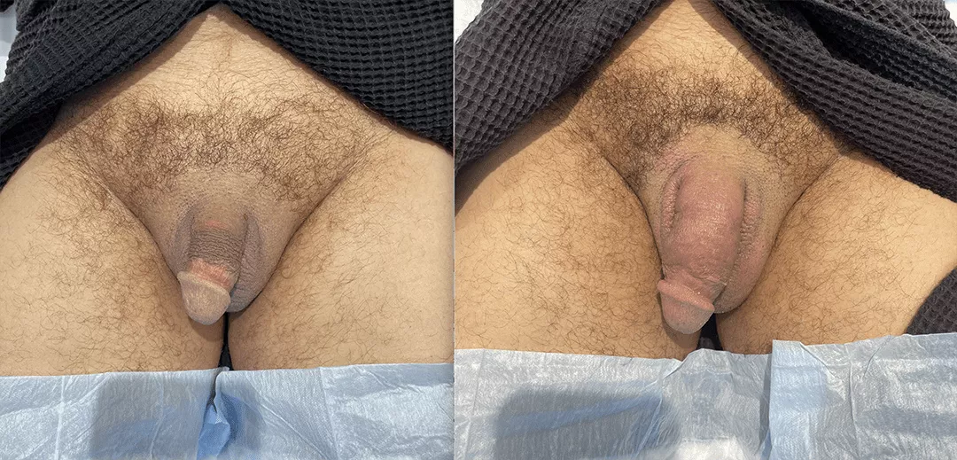 penile-filler-250277-bxa3