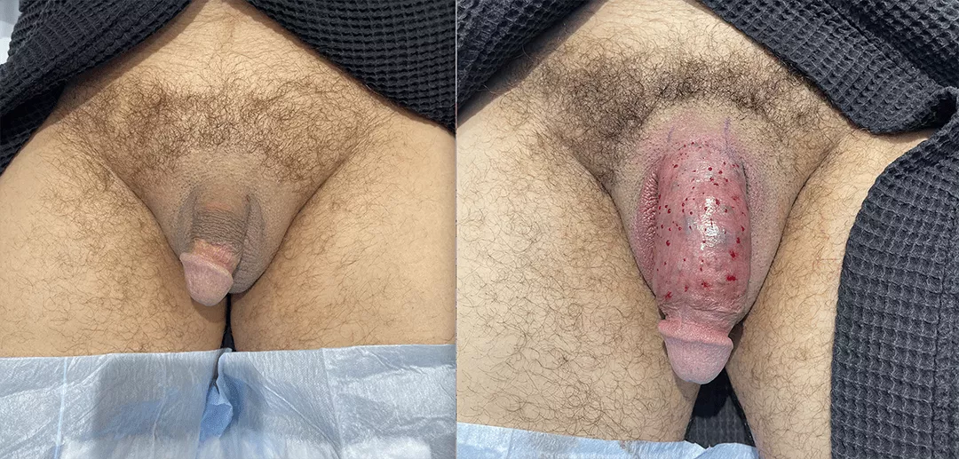 penile-filler-250277-bxa5