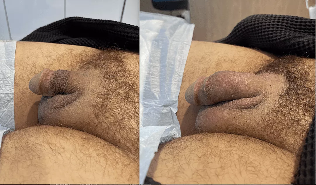 penile-filler-250277-bxa9