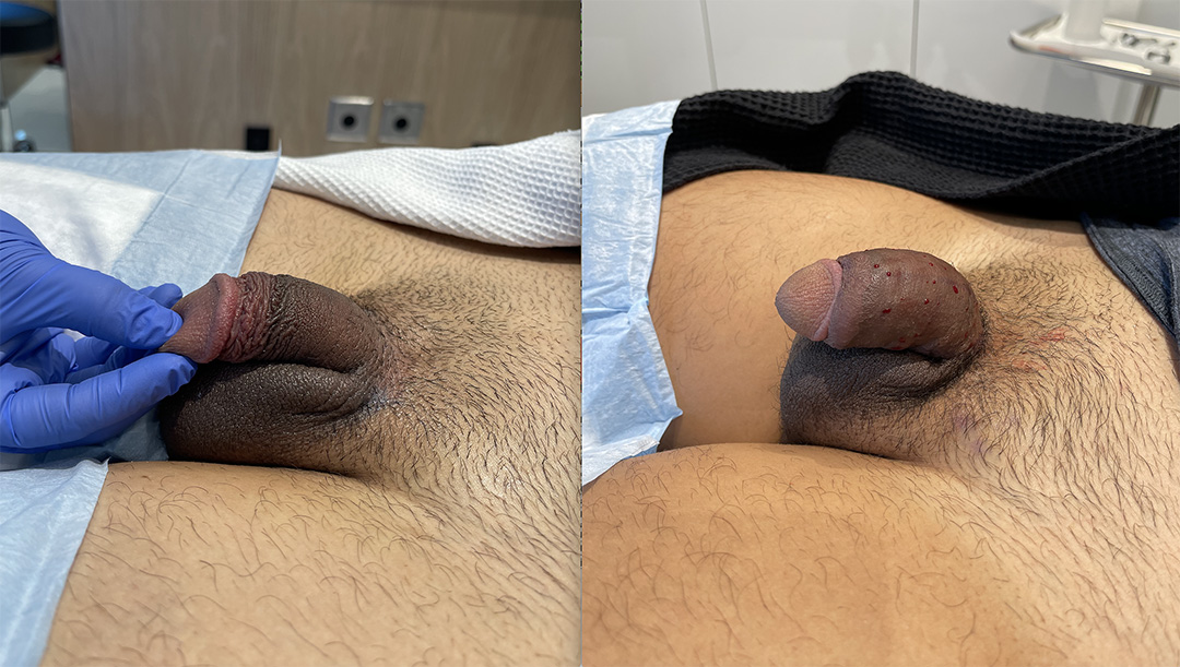penile-filler-250595-1