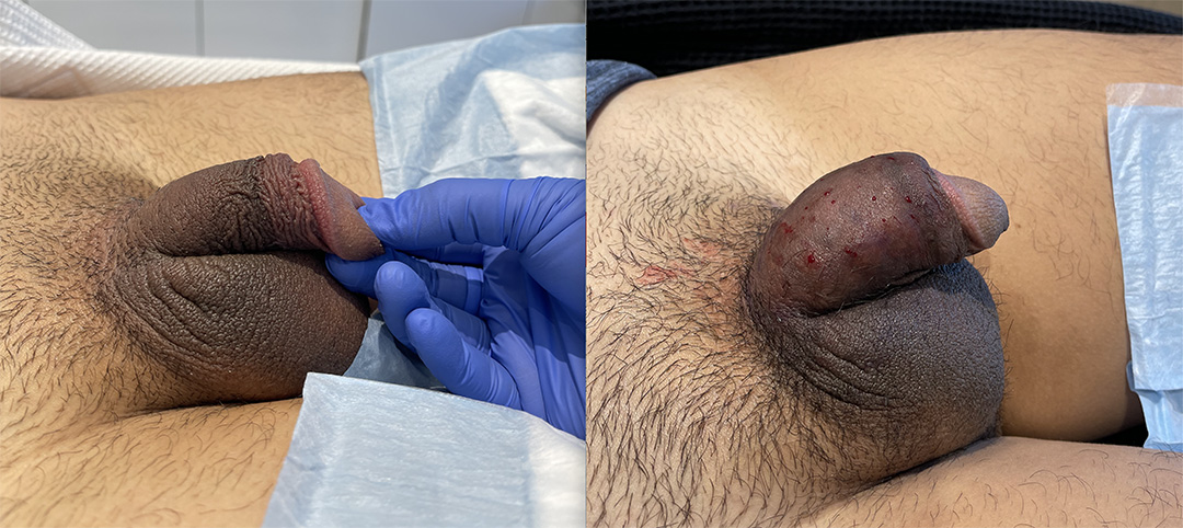 penile-filler-250595-3