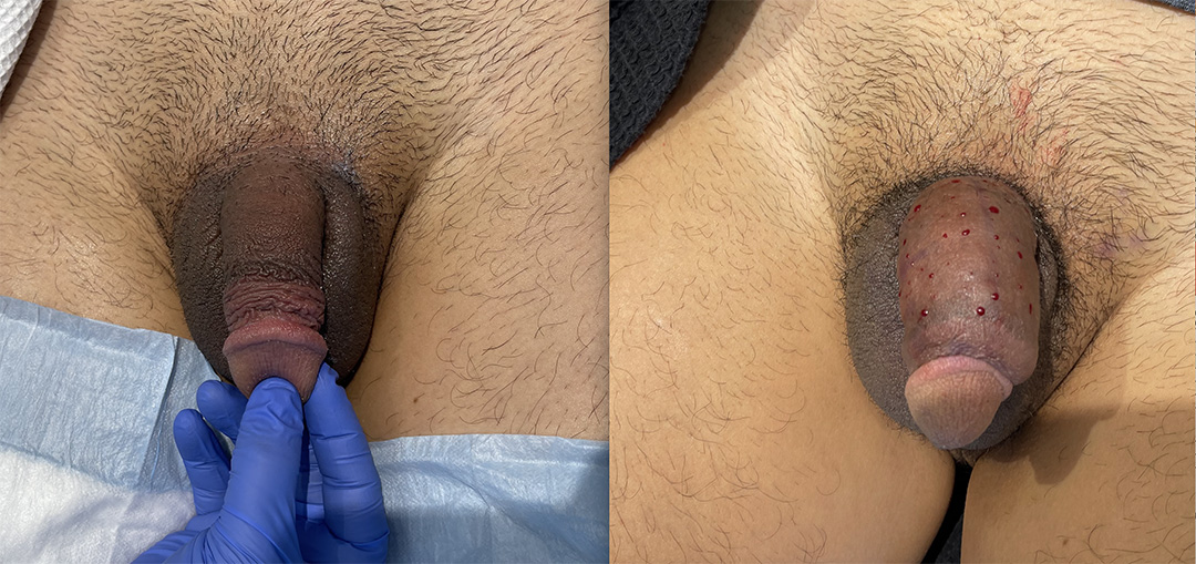 penile-filler-250595-4