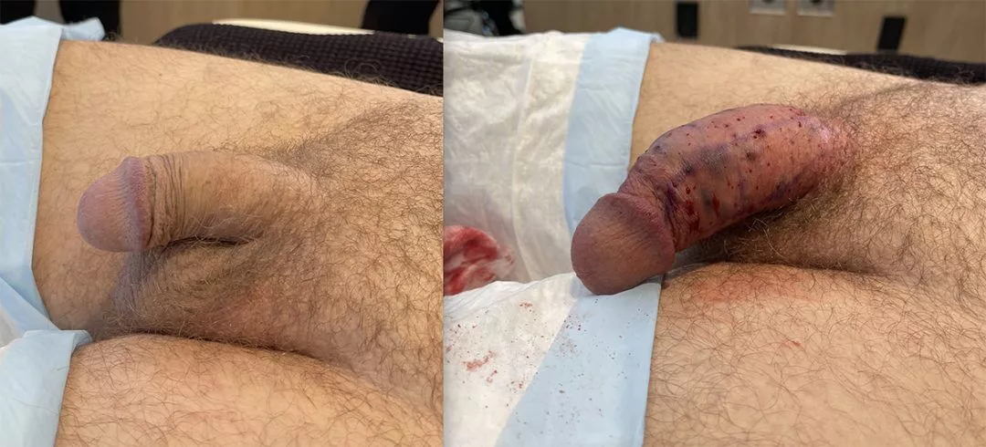 penile-filler-ba-1080x490