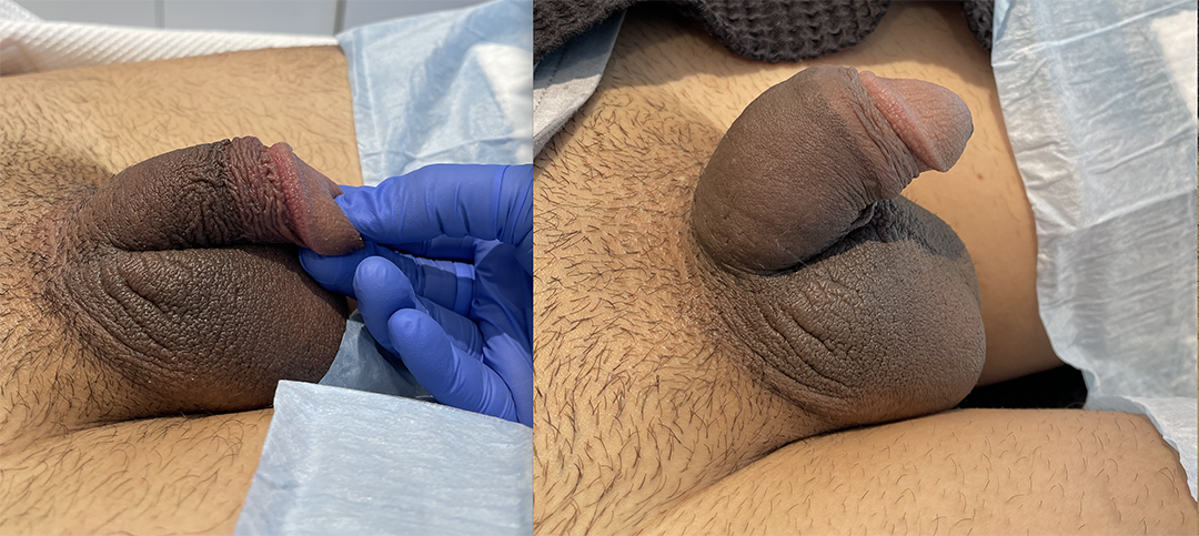 penile-filler-ba-250595-4