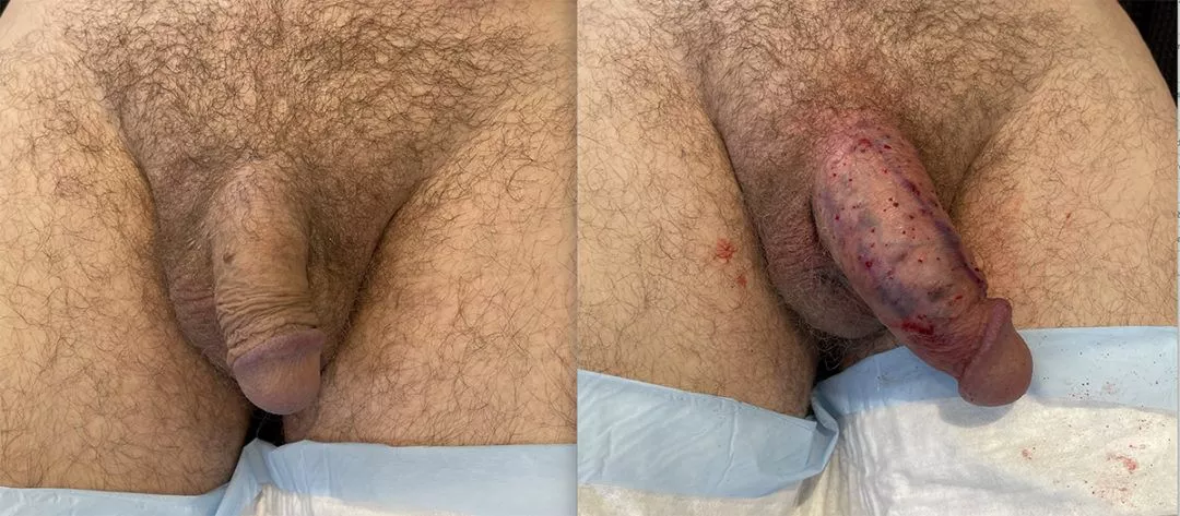penile-filler-ba2-1080x473