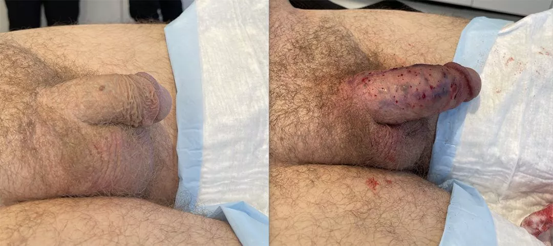 penile-filler-ba3-1080x482