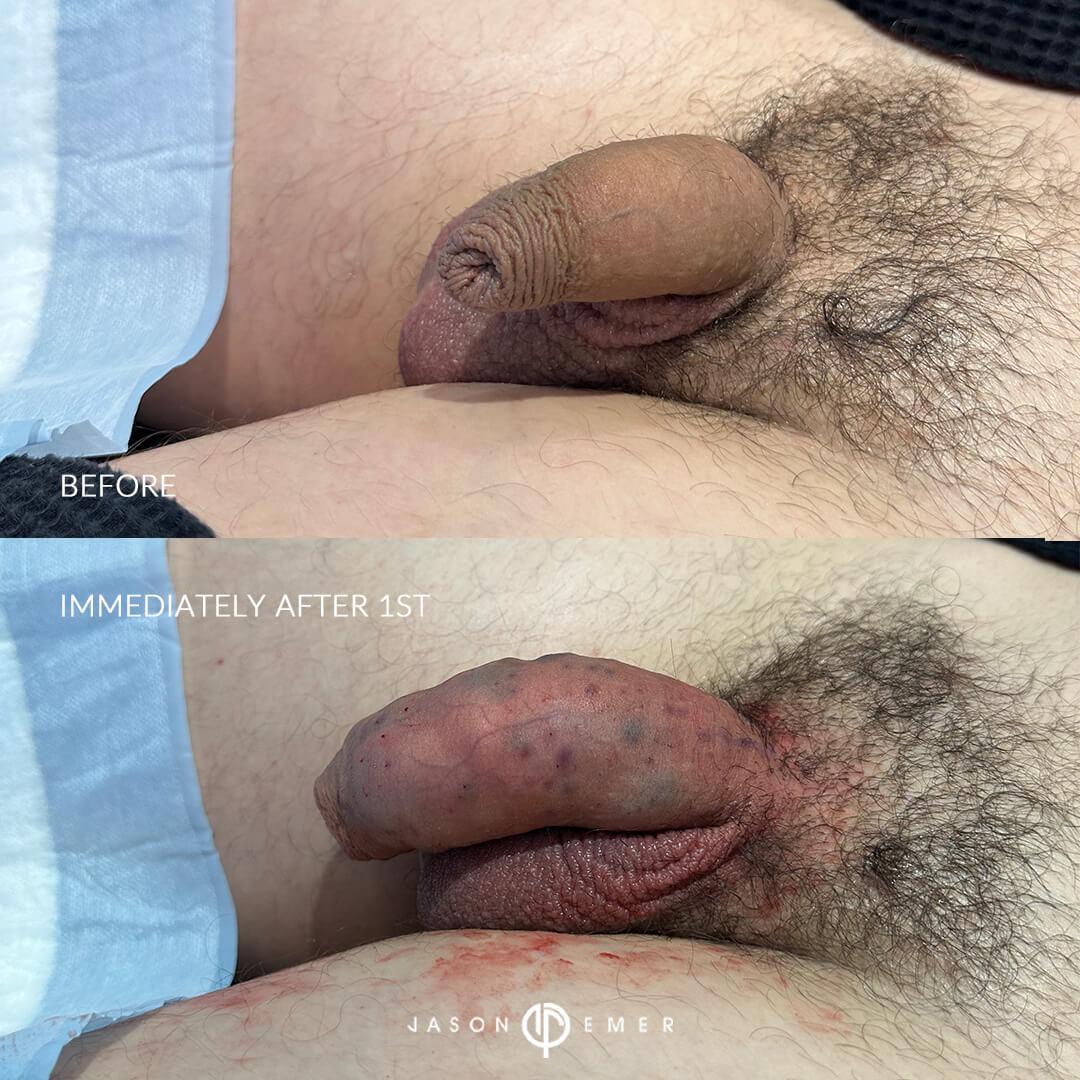 BA2_Immediately after 1st_left