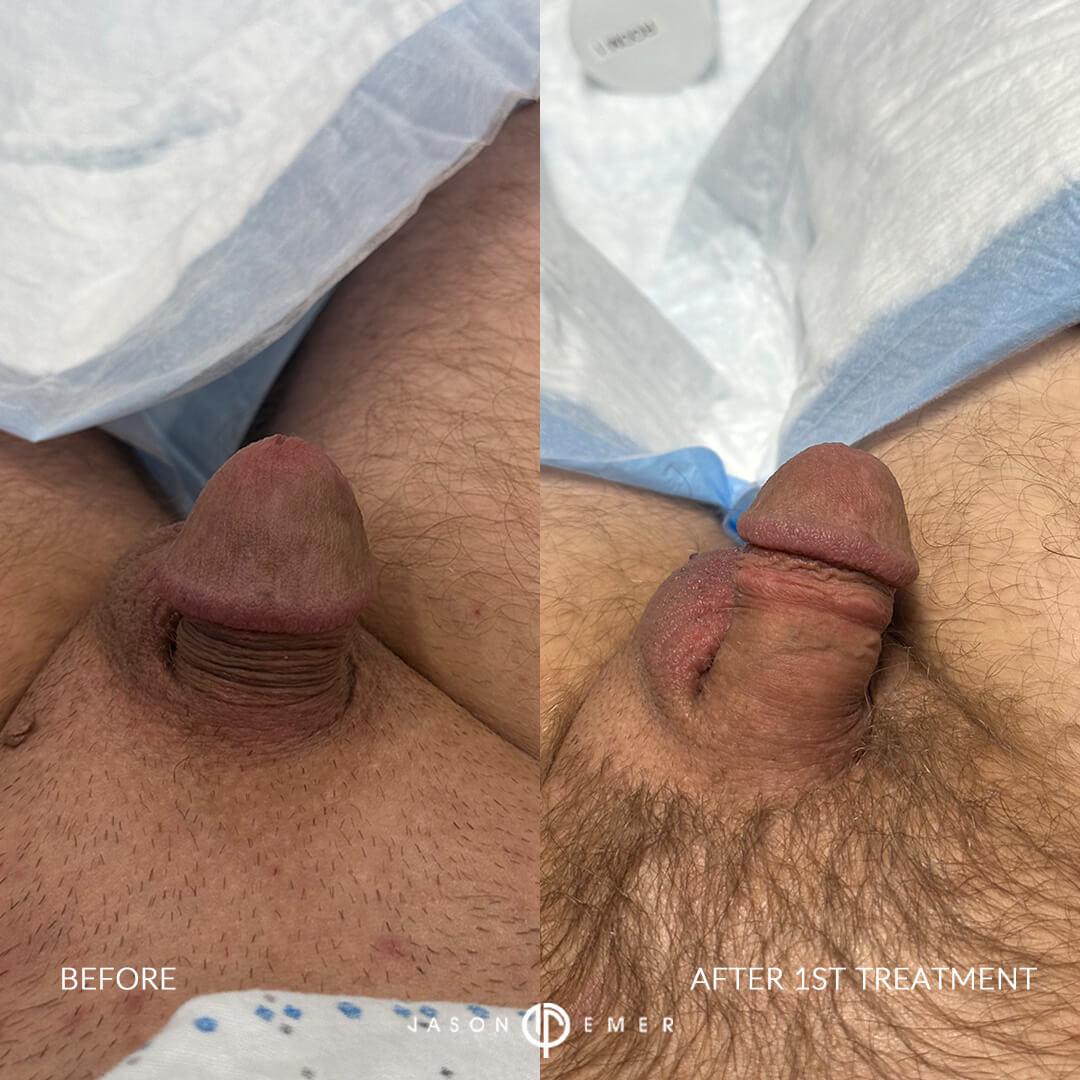 BA2_after 1st_front2