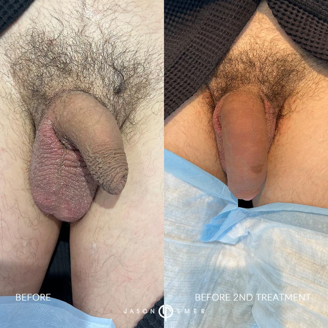 BA2_before 2nd_front