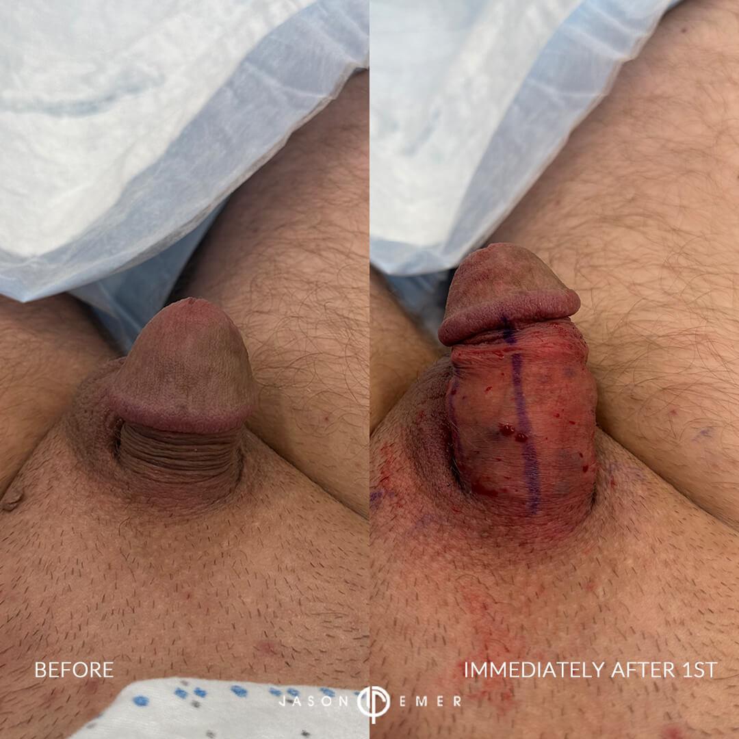 BA2_immediately after 1st_front2