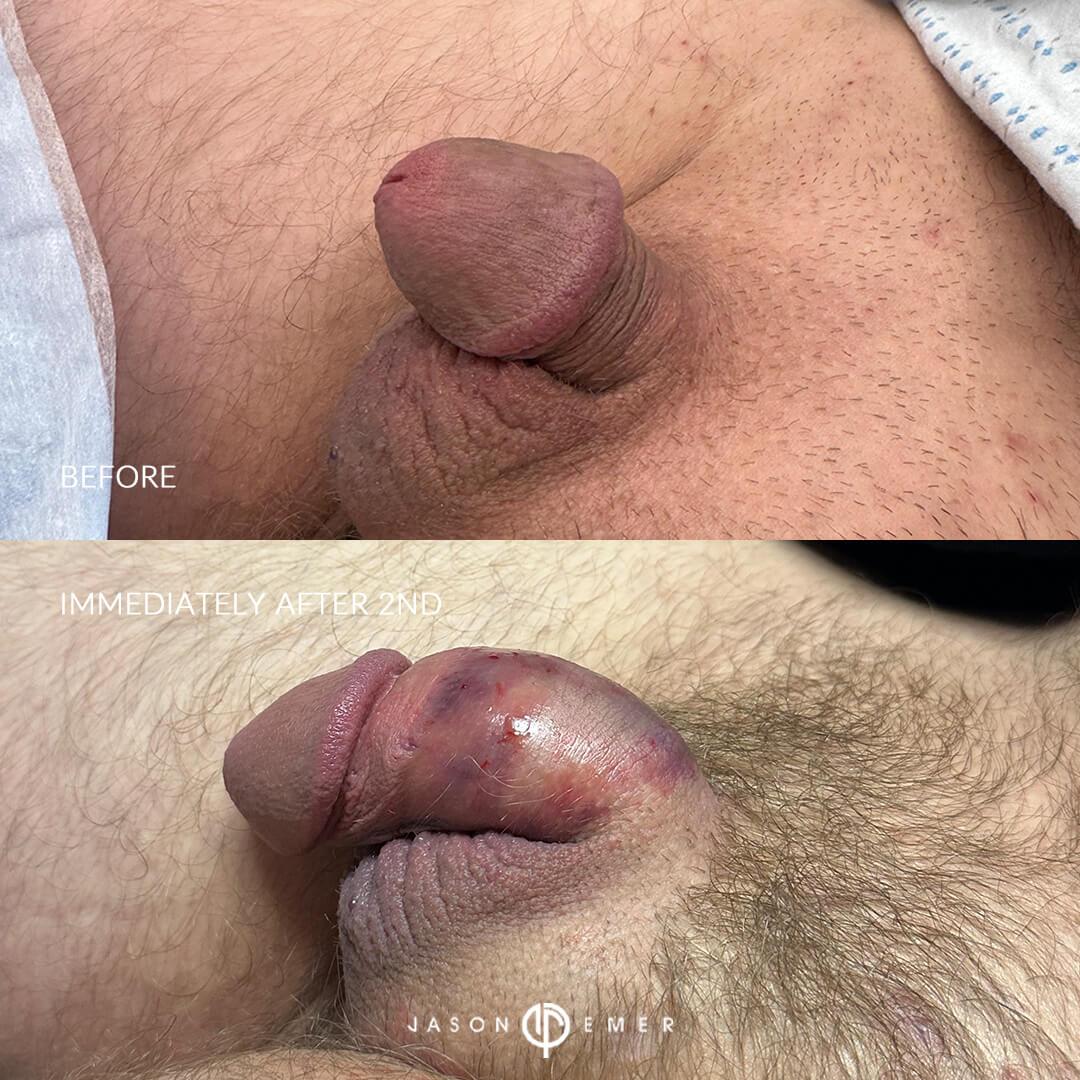 BA2_immediately after 2nd_left