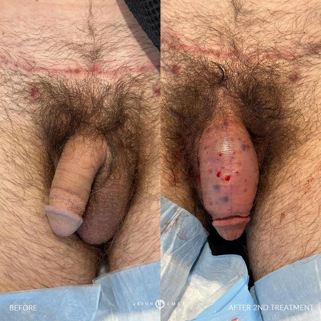 ba2nd treat front222