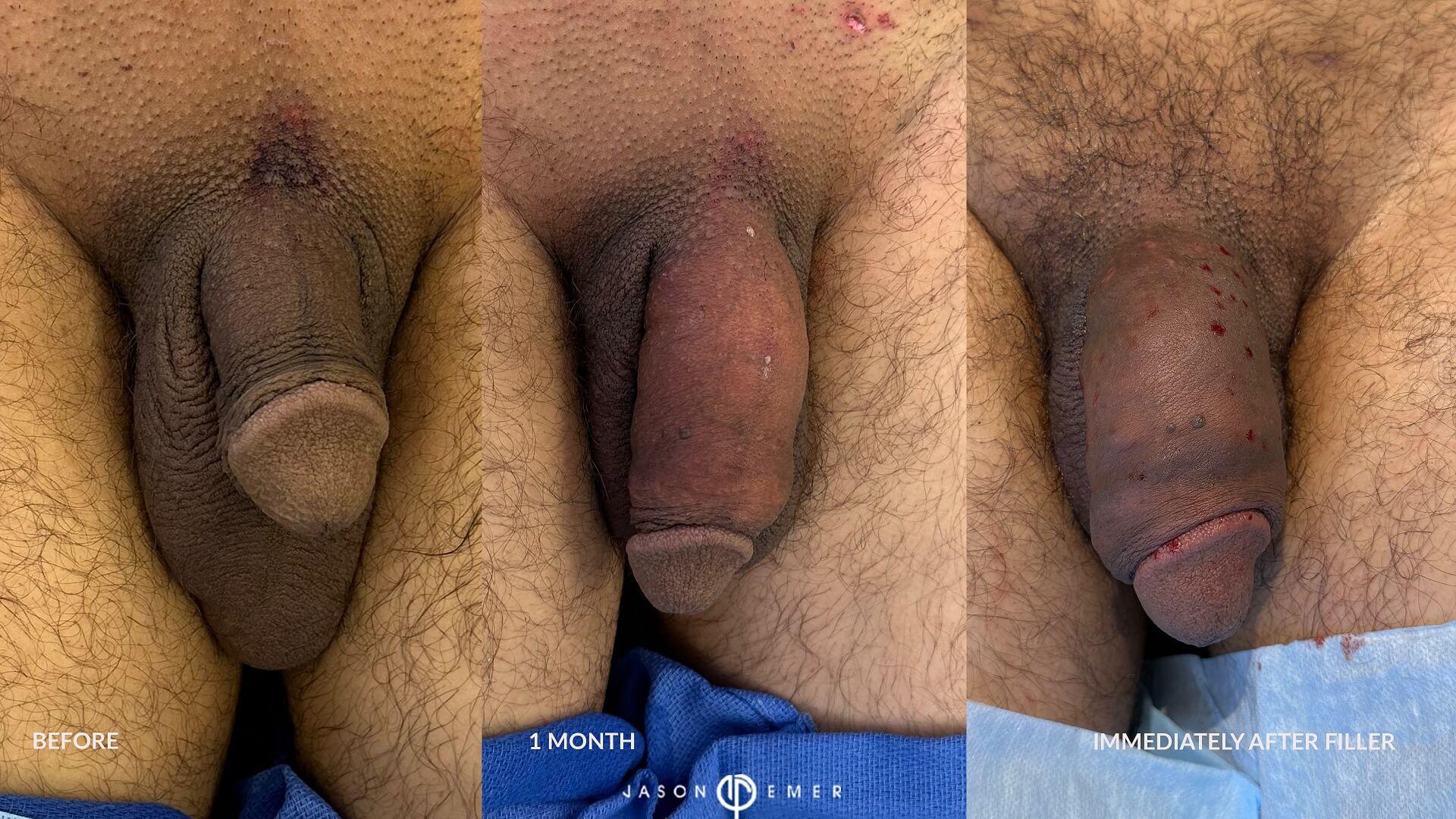 before and after fat graft and after filler tx 3 front