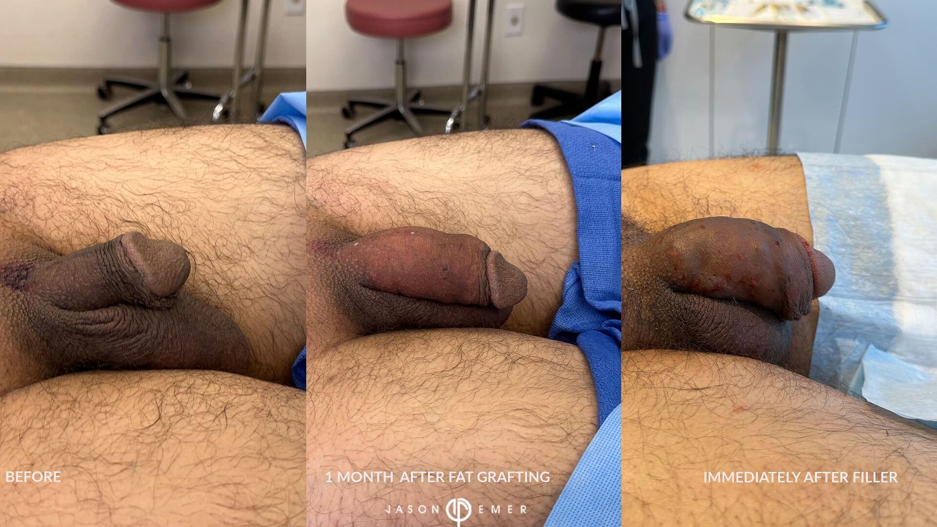 before and after fat graft and after filler tx 3 side