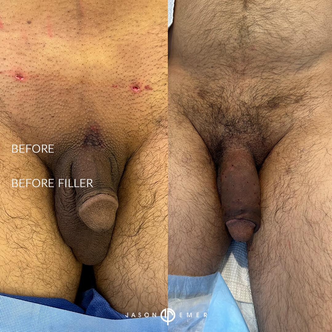 before and after filler tx 3 front