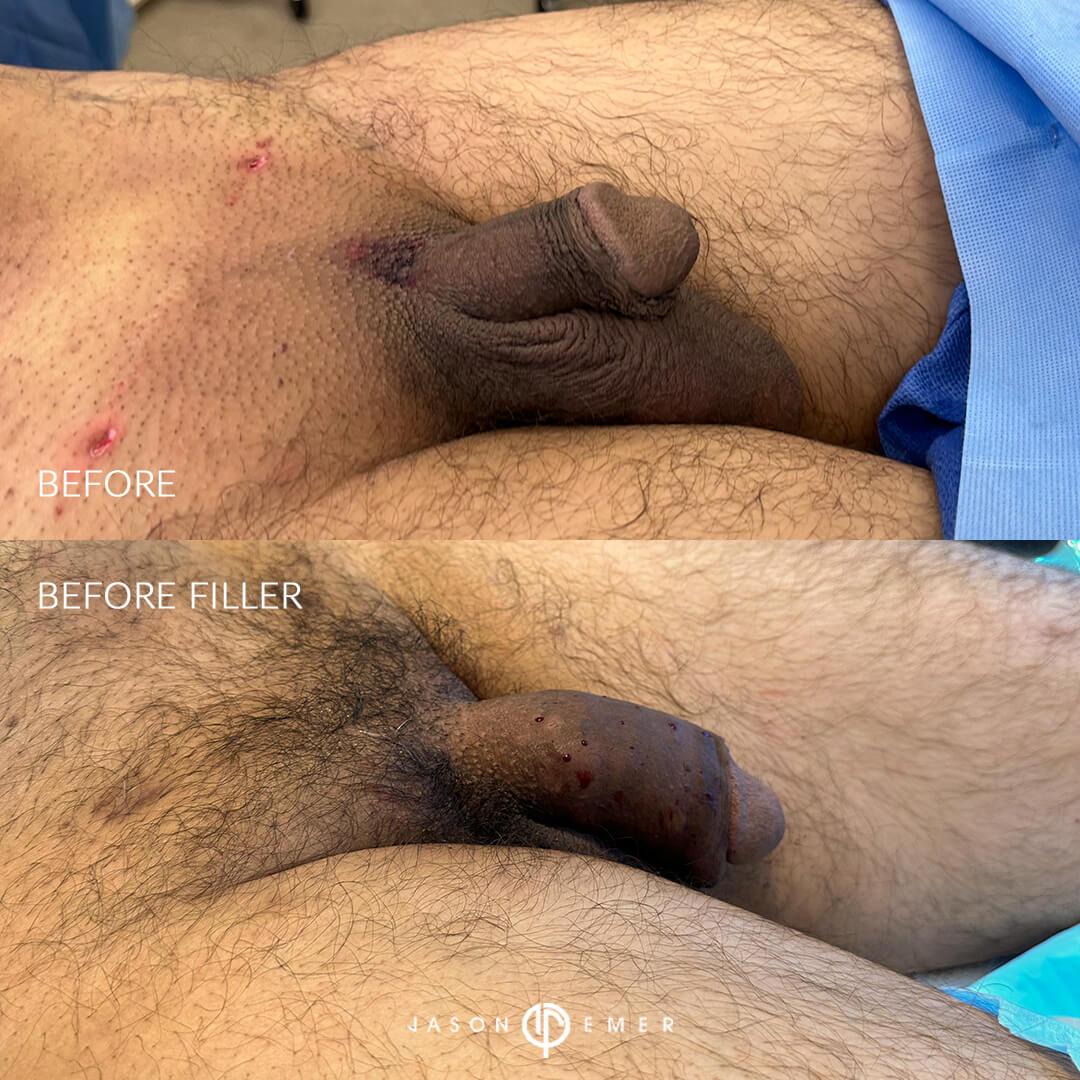 before and after filler tx 3 side