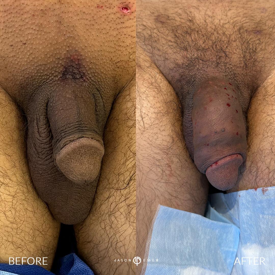 before and after front