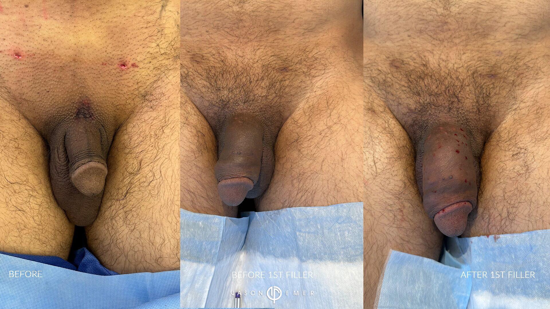 before and before filler tx 1 and after filler tx 1 front