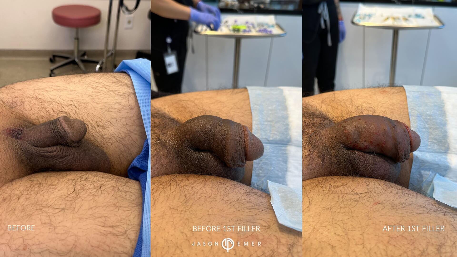 before and before filler tx 1 and after filler tx 1 side