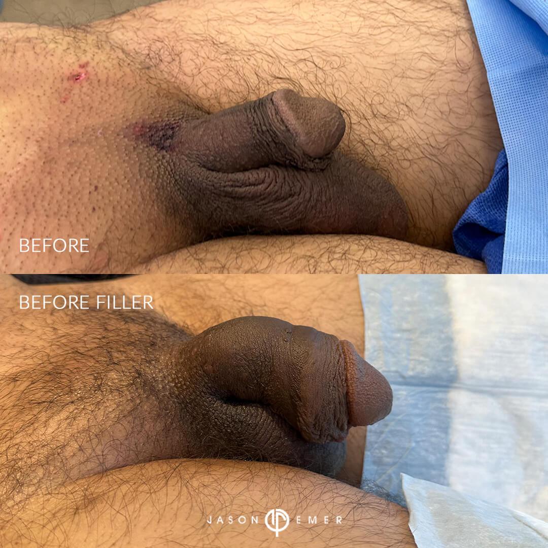 before and before filler tx 1 side