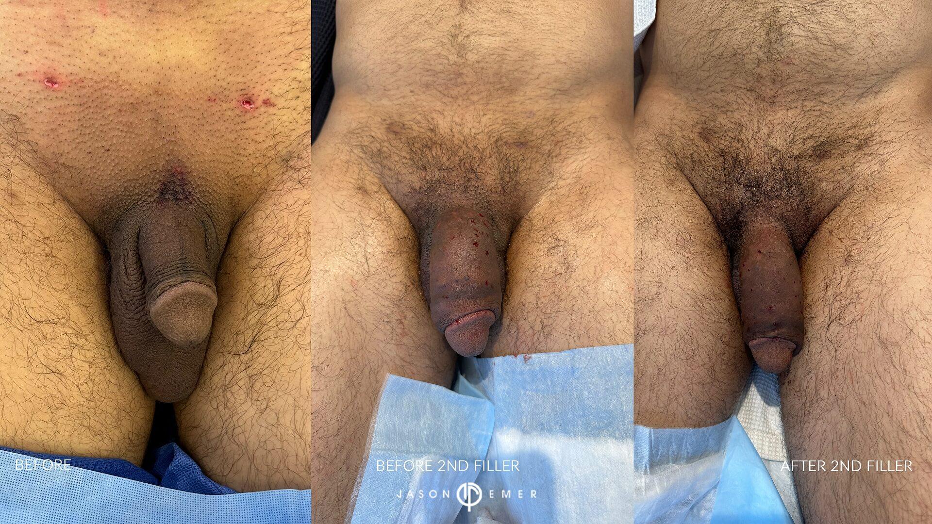 before and before filler tx 3 and after filler tx 3 front