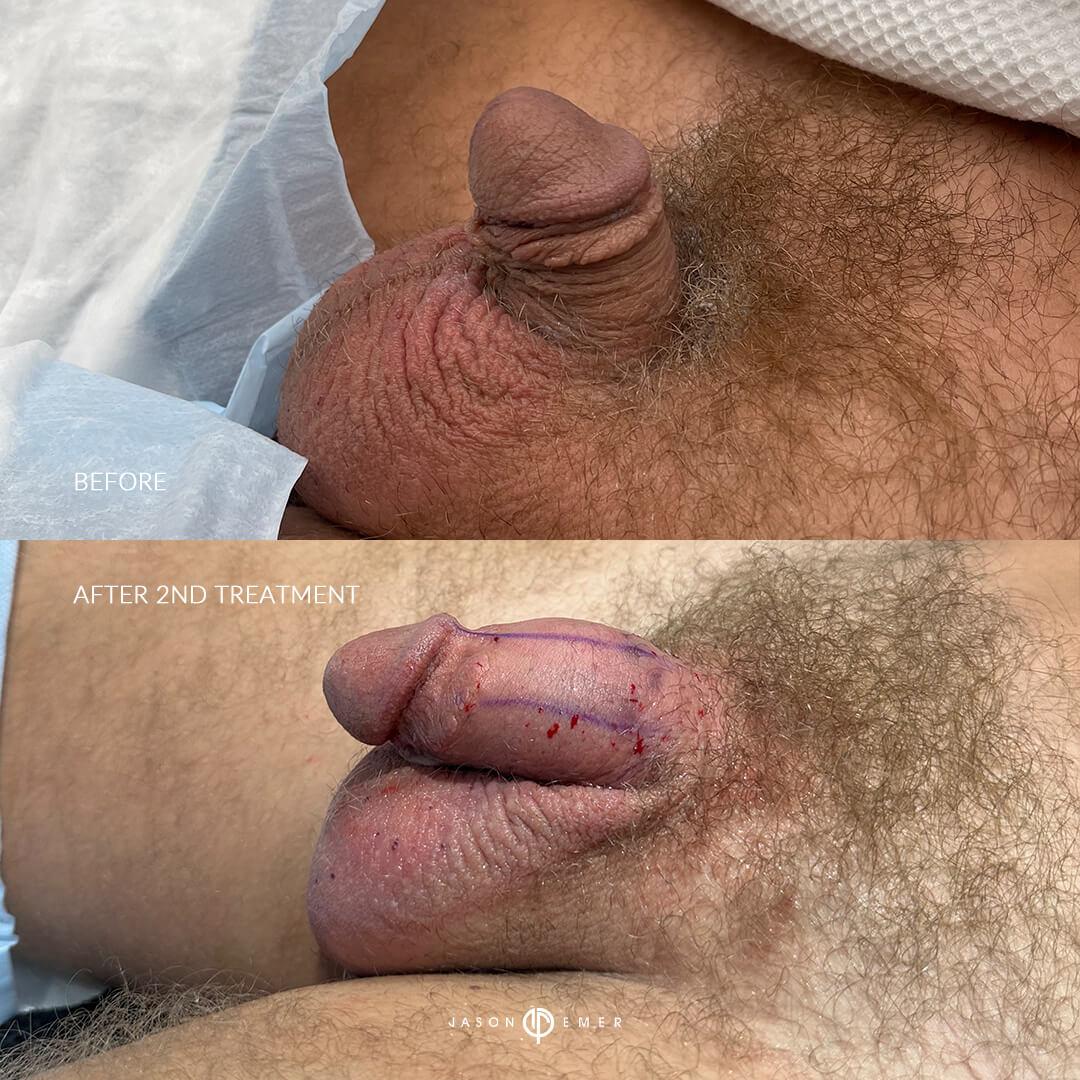 BA2 after 2nd left (1)